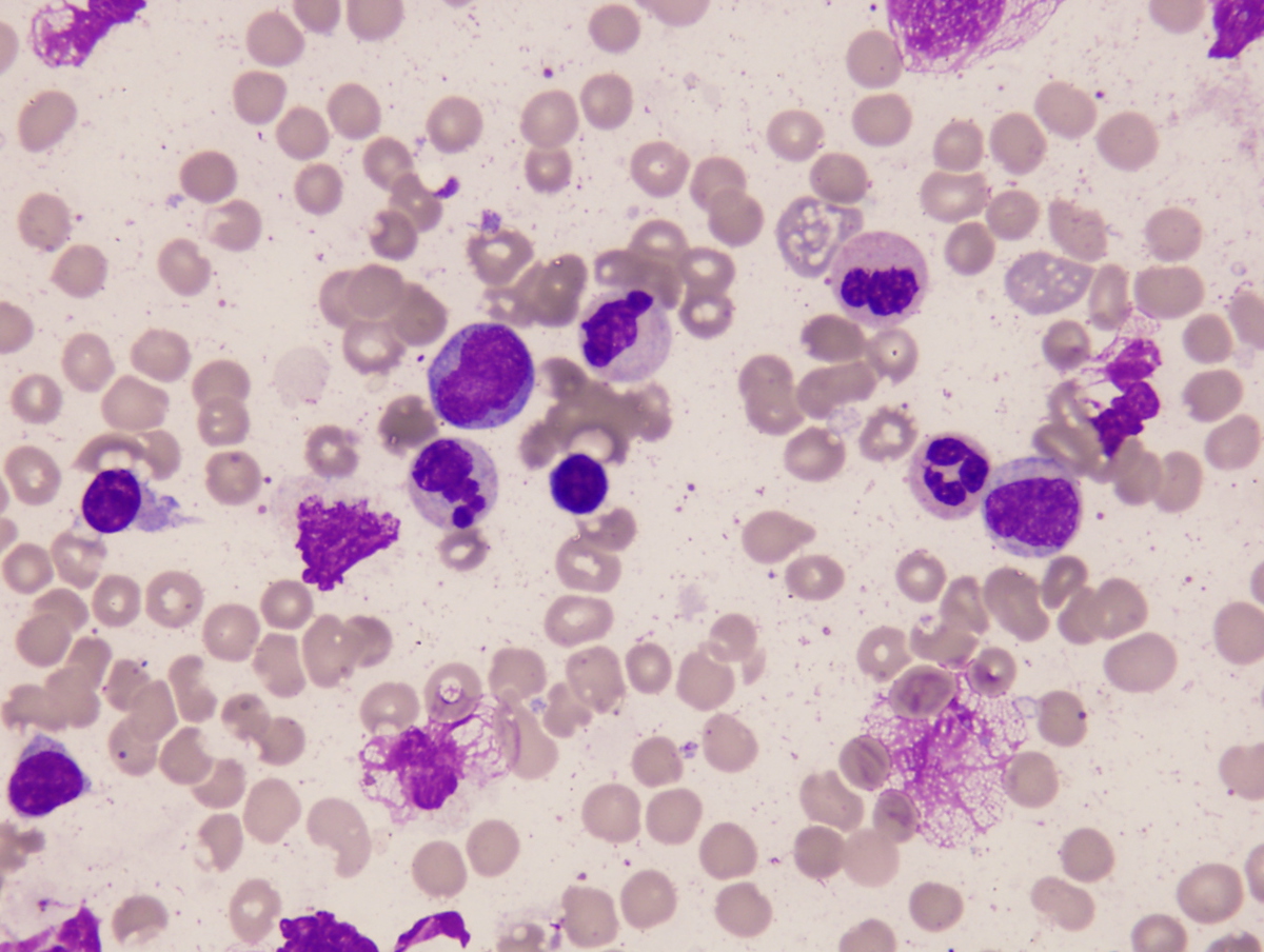 Bone marrow aspirate